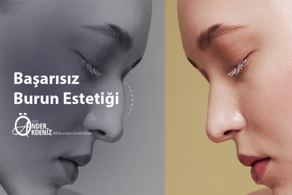 Başarısız Burun Estetiği